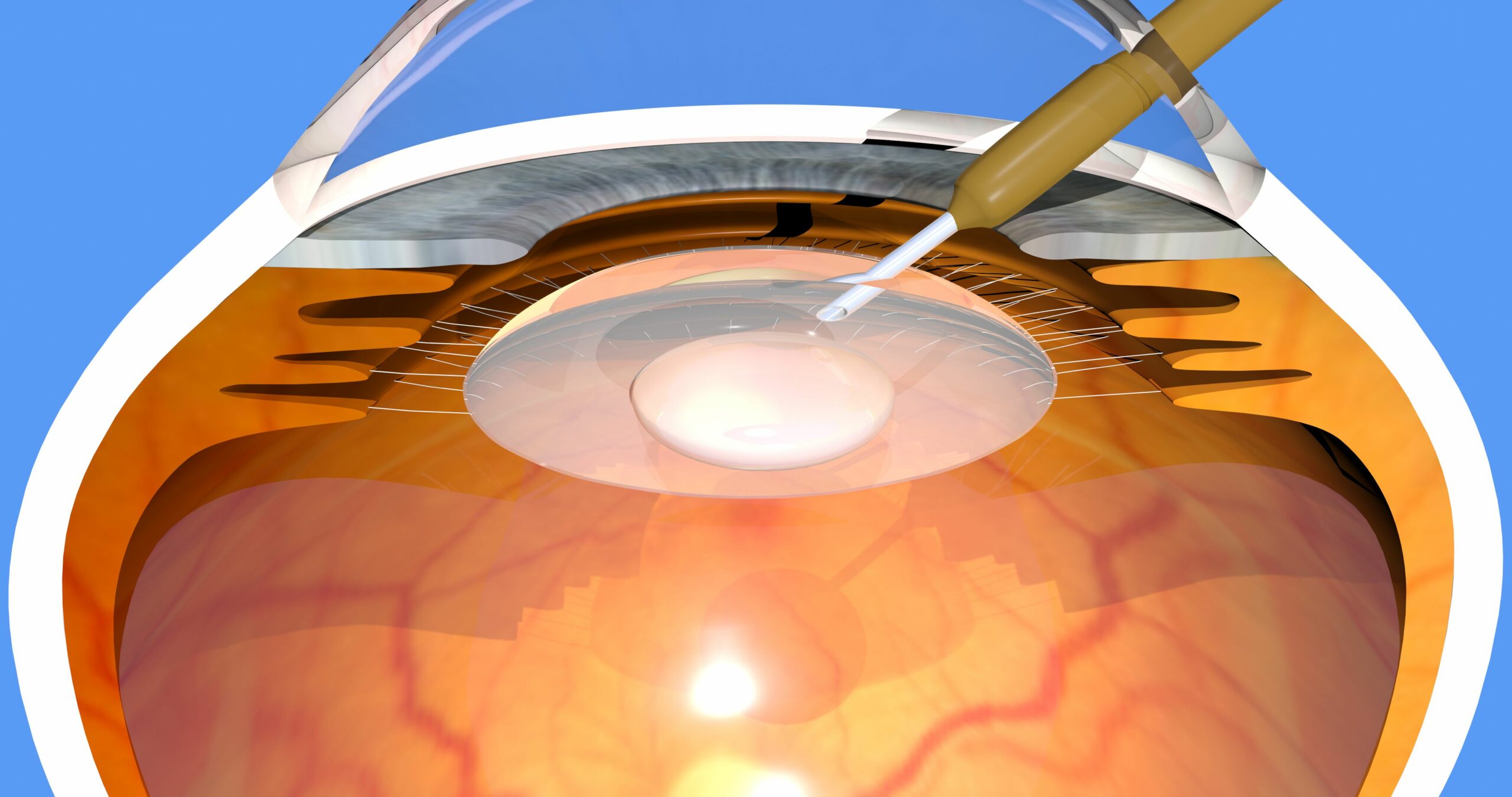 You are currently viewing What are the possible causes of cataracts?