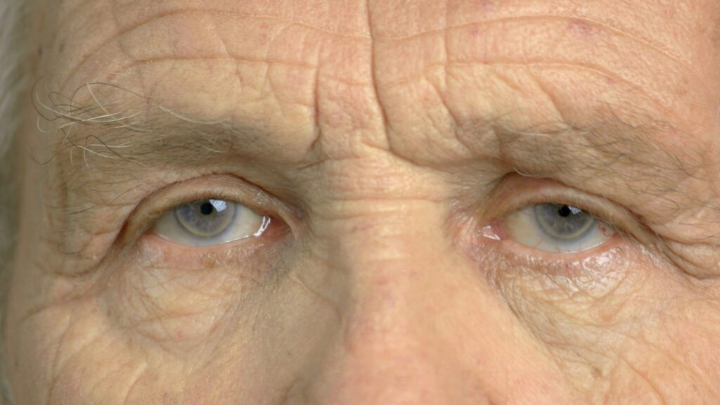 What are the shortcomings of cataract surgery?